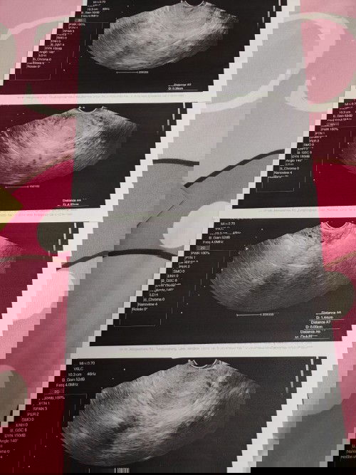 ซาว์ดผ่านทางช่องคลอด