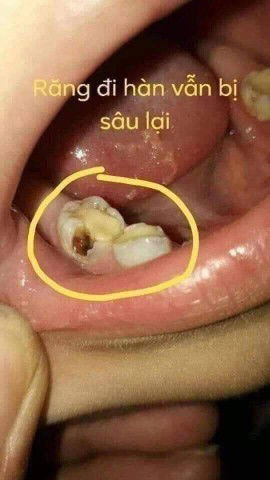 Sâu răng ở trẻ nhỏ m nên chú ý nhé