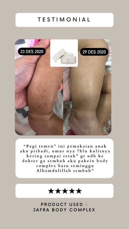 Kulit Bayi Kering dan Alergi
