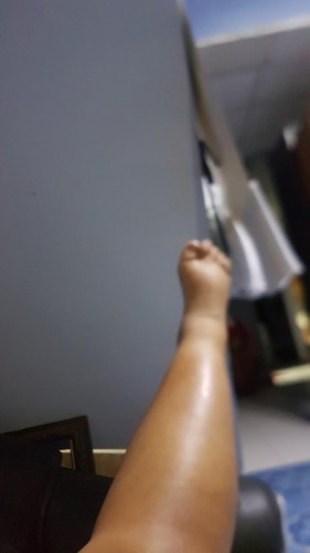 บวมรึอ้วนคะ