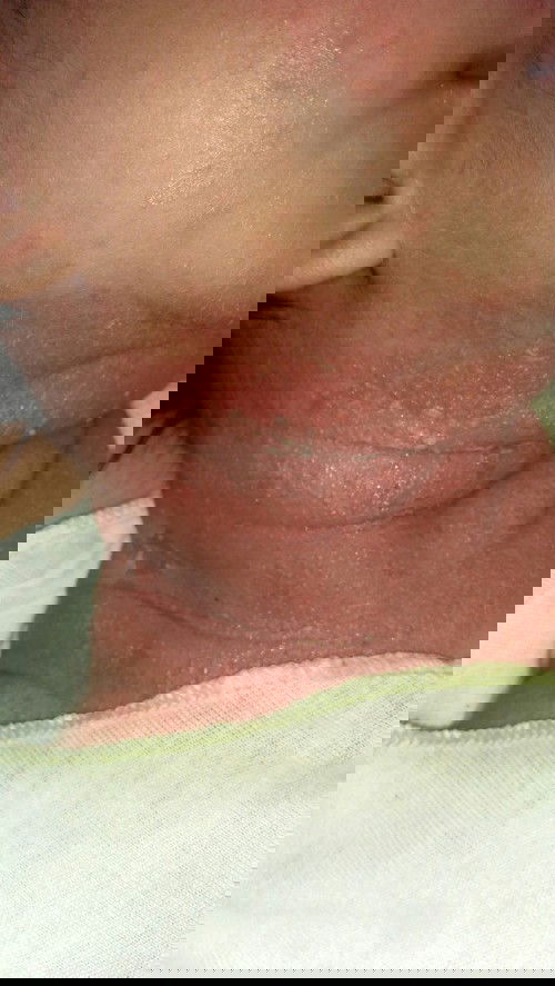 bunda adakah yang anak.nya terkena alergi panas