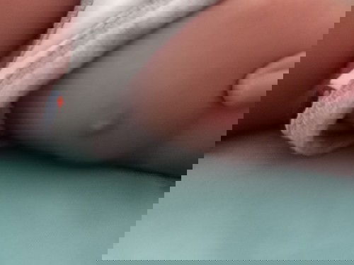 Mengatasi Bisul pasca imunisasi Bcg