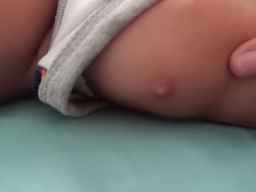 Mengatasi Bisul pasca imunisasi Bcg