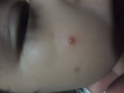 bakit may tumutobo sa mukha nang anak ko at lalong lumalaki 😭