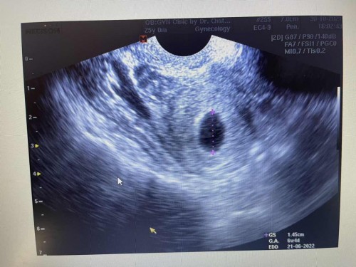 สวัสดีค่ะ ครรภ์6week4วัน เจอแค่ถุงการตั้งครรภ์+ถุงไข่แดง ผิดแกติไหมคะ กังวลว่าจะท้องลม อยากมีลูกมากๆๆๆๆ ขอคำแนะนำสำหรับคุณแม่หน่อยค่ะ เราพึ่ง ท้องแรก