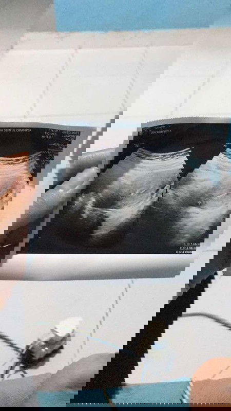 Belum ada kantung kehamilan