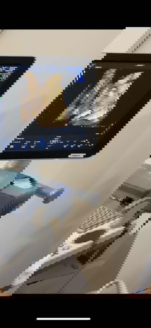 น้ำตาจะไหล ลูกชายนอนคว่ำ หมอให้เดิน10นาที ให้กินน้ำเย็นก็ไม่ขยับ เห็นหน้าไม่ชัด ต้องมาซาวให้อีก4สัปดาห์
26w2d