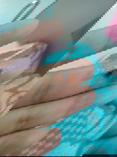 มูกเลือดหลังกลับจากโรงพยาบาล