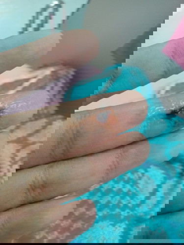 มูกเลือดหลังกลับจากโรงพยาบาล