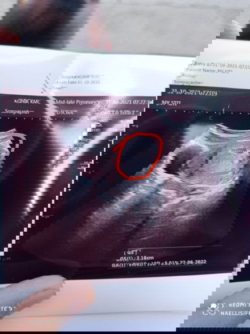 Hitungan bidan beda dengan usg apa wajar