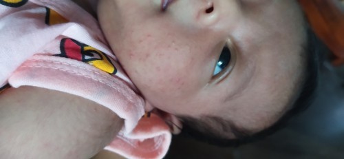 ลูกเป็นผื่นที่หน้า