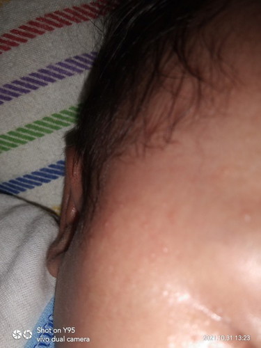 Bintik muka di bayi
