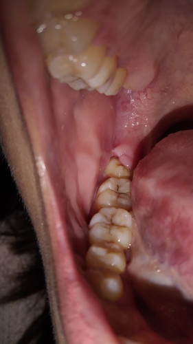 Namamaga at Nakausli na laman ng bagang