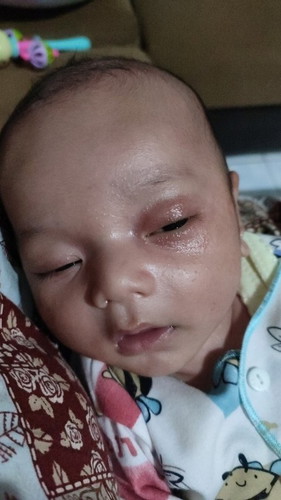 Sakit mata pada bayi 1 bulan