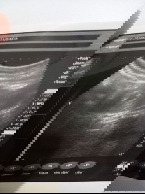 Pendarahan di usia 7 week