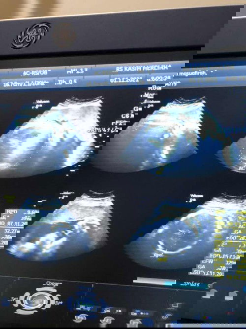 37 wks lilitan leher 1x