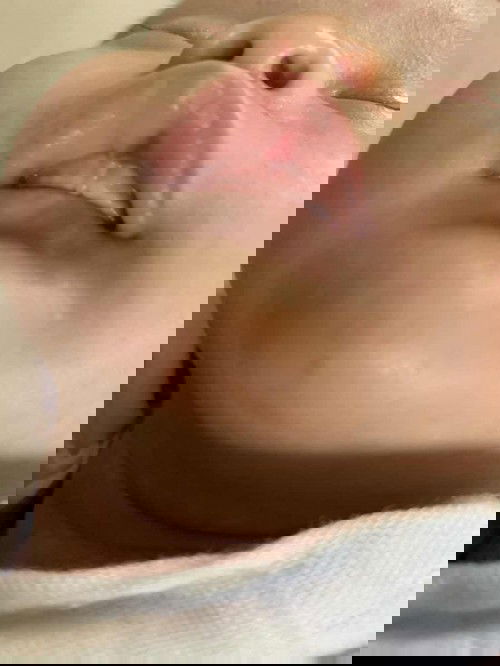 Các mẹ ơi cho e hỏi, môi trên con e tự nhiên bị đỏ như này là bị sao vậy ạ.