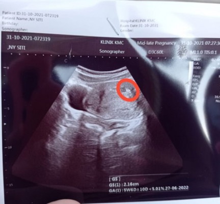 Kaya ada janin kecil