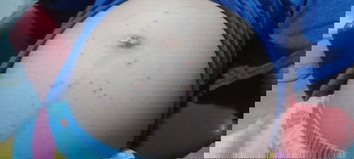 หน้าท้องมีตุ่มขึ้น #ท้องแรก