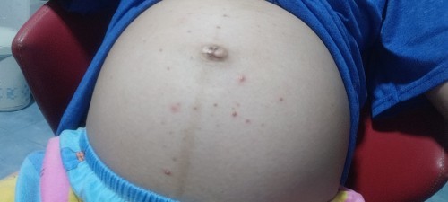 หน้าท้องมีตุ่มขึ้น #ท้องแรก