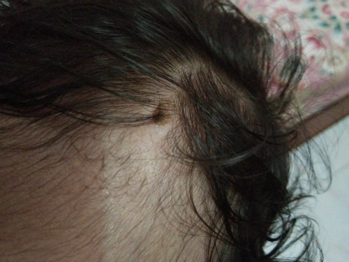 Kepala bayi ada berair dan jadi kerak