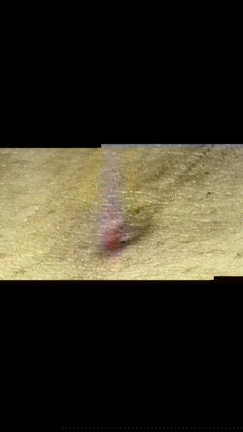 Cesarean Wound Infection