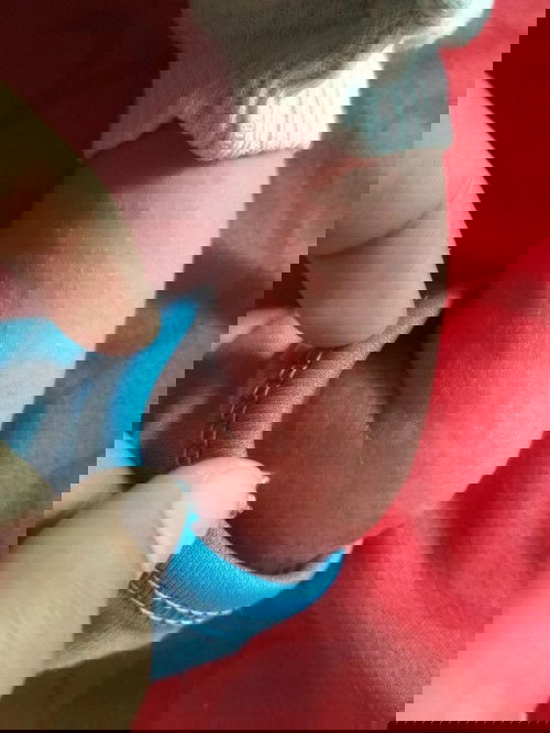 bruntusan isi cairan dan pecah jadi basah terus jadi kerak