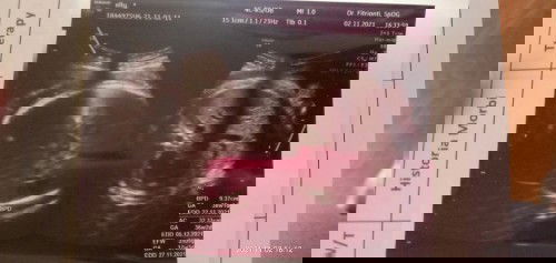 Cara membaca hsil usg