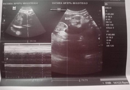 ULTRASOUND RESULT