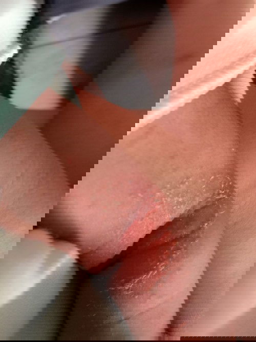 Recommended salep atau obat