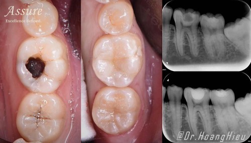 Bạn biết gì về răng sâu?