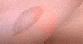 Obat jamur anak dan ibu menyusui