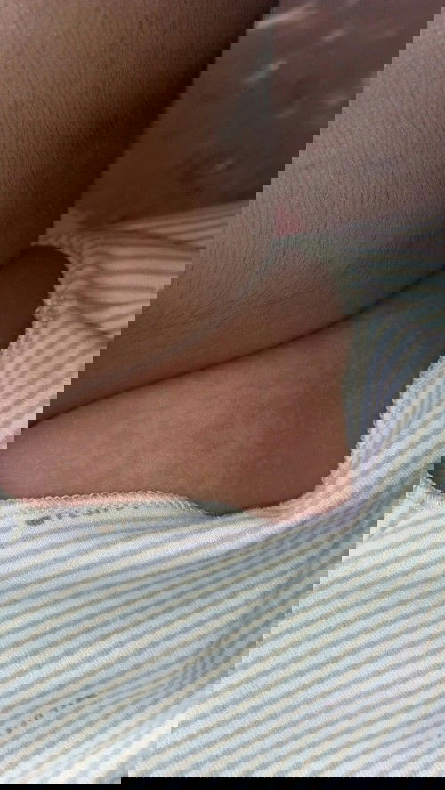 Biang keringat berubah menjadi bercak putih