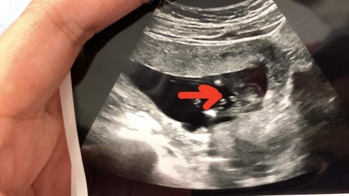 อัลตร้าซาวน์ 14 weeks