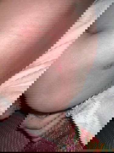 Hello, can i ask if this is normal? Baby is about 11 weeks old and there is blood on the bcg injection. Thank you!