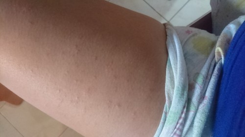 Rashes on 3rd Trimester