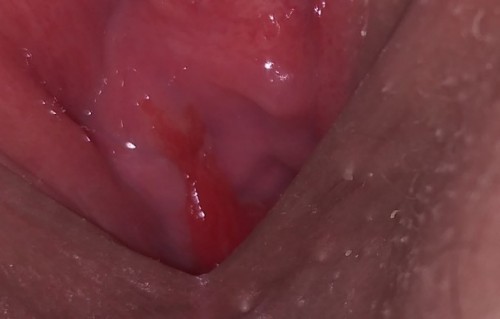 ใครรู้บ้างคะว่าสีแดงๆสดๆข้างในมันคืออะไร  ครั้งนี้ครั้งที่2แร้วที่มี  ครั้งแรกหมอบอกผนังมดลูกคะ😫