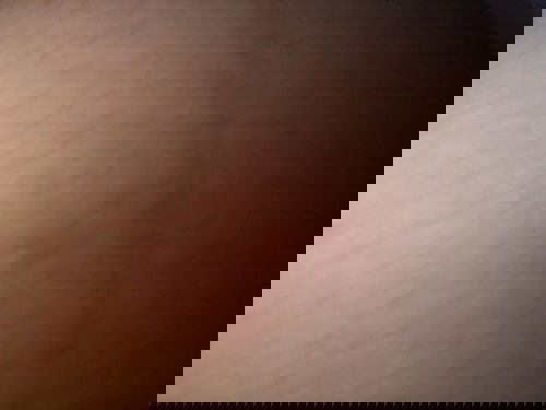 ตุ่มคันที่ท้องมีวิธีแก้หรือบรรเทายังไงบ้าง