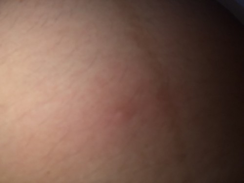 ตุ่มคันที่ท้องมีวิธีแก้หรือบรรเทายังไงบ้าง