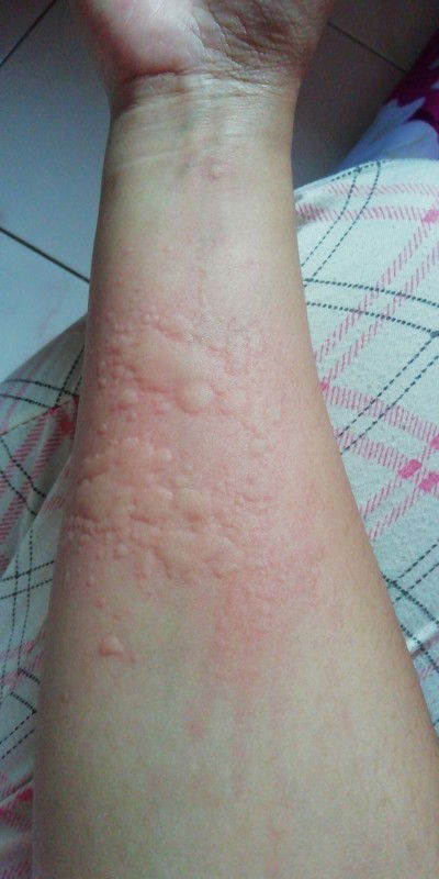 Adakah Yg Alergi Kerang Seperti Saya, Aga Takut Makan Seafood Skrg Apalagi Lagi Hamil Muda Bgini ? P