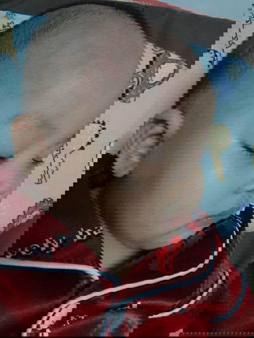 ผื่นแบบนี้เกิดจากอะไรคะ แล้วนานไหมกว่าจะหาย