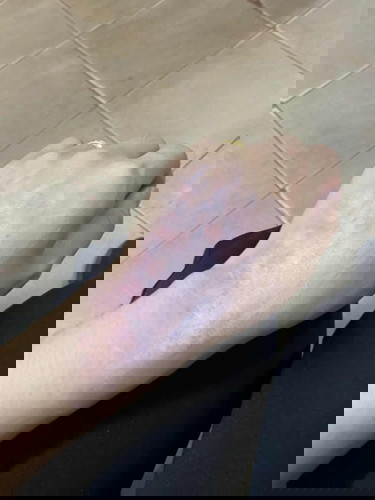 ท้อง4เดือนกว่า มีอาการคันตามตัว