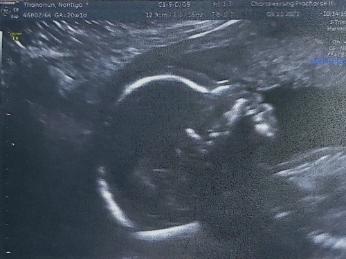 อัลตร้าซาวด์ครั้งแรก 20 Weeks