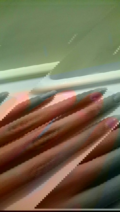 Kulit jari tangan seperti kapalan & gatal