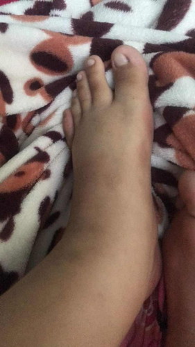 คุณแม่ๆๆคนไหนขาแขนบวมบ้างค่ะ
ตอนนี้บวมครั้งที่3แล้ว กลัวคลอดก่อนกำหนด มีอาการท้องแข็งเป็นบ้างครั้งค่ะ