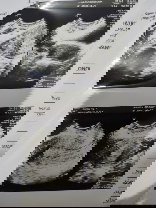 Hamil tapi tespack lagi hasil negatif