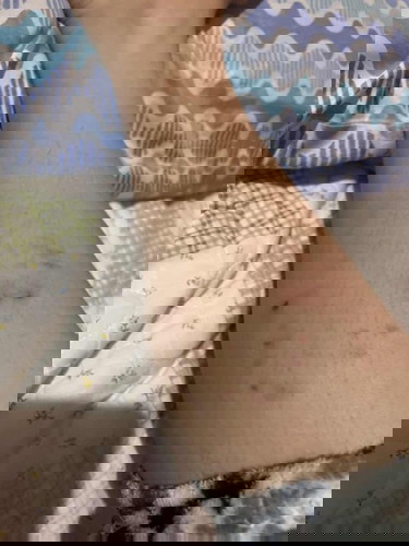 mga mommies, tulong naman po. nakagat ako ng aso kanina bawal na ba ako mg bf kay LO? 😢😭