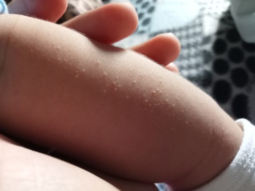 Red dots sa anak ko