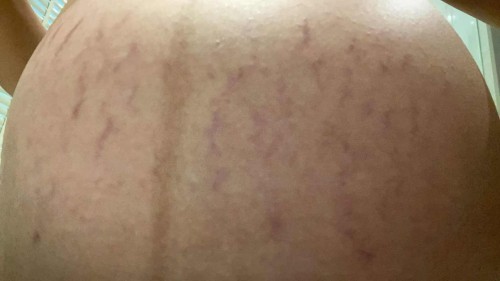 ใครเป็นบ้างค่ะแตกลายต้องใช้คลีมอะไรถึงจะหายค่ะ😭