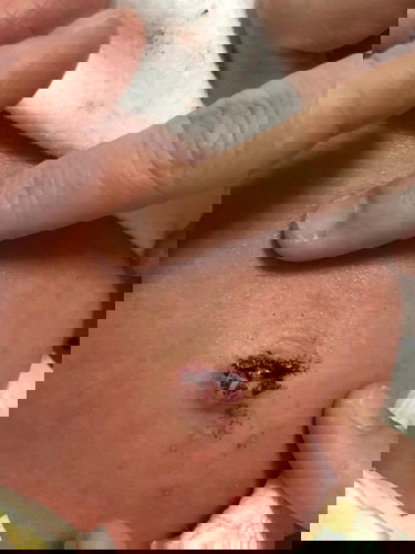 Bleeding belly button in 2 weeks old
